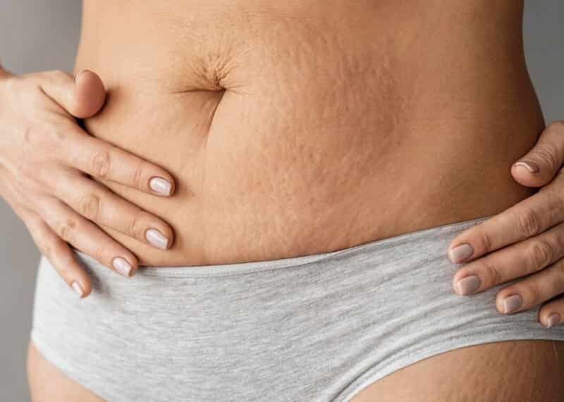 Best Natural Oil for Stretch Marks